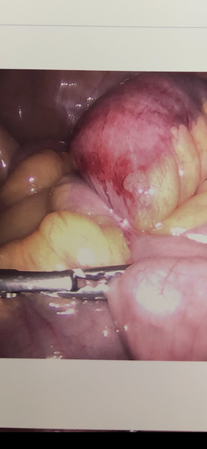 Closed-loop bowel obstruction due to adhesion