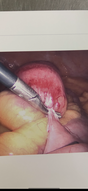 Closed-loop bowel obstruction due to adhesion