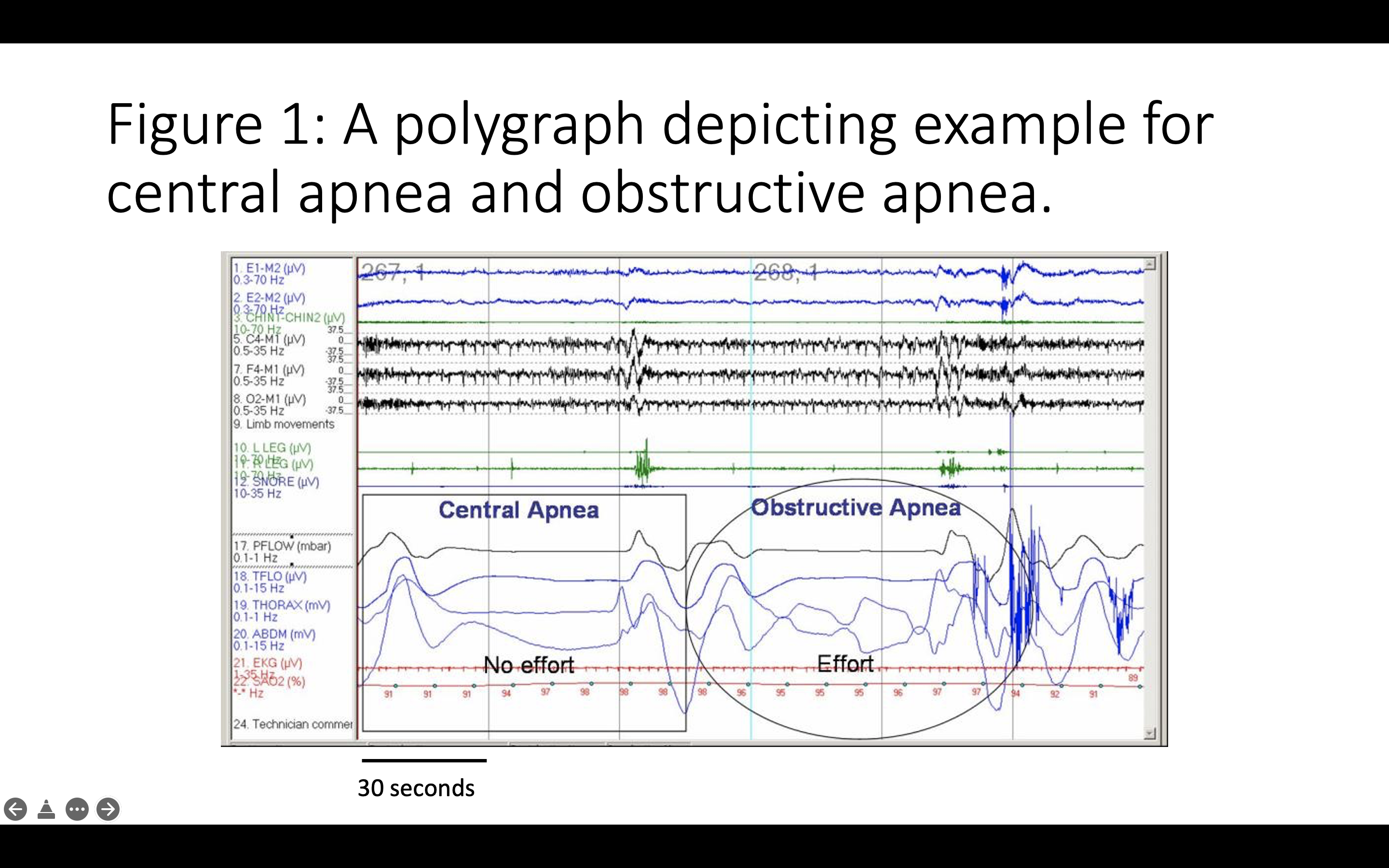 A polygraph depicting example of central and obstructive apnea.