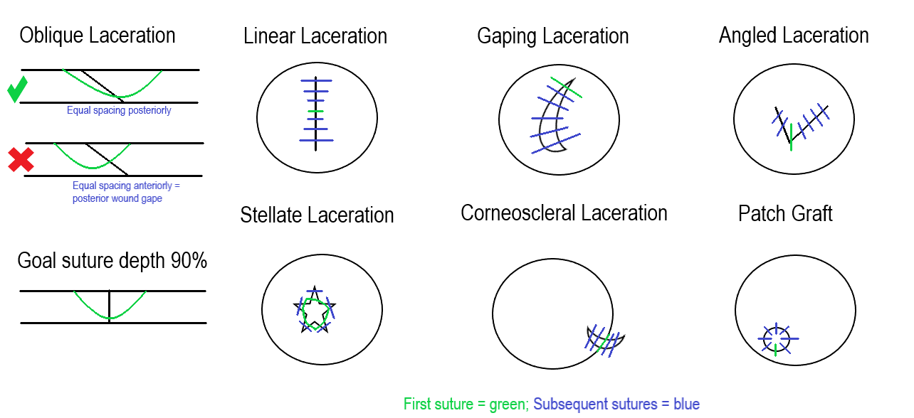 Corneal laceration suture techniques and guidelines