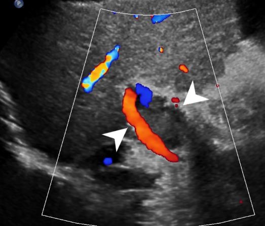 Portal vein thrombosis