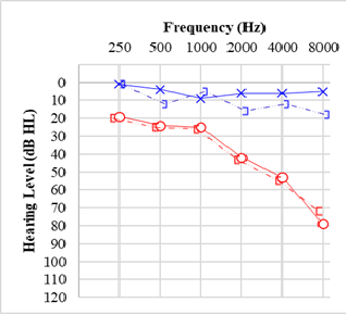 <p>Audiogram for Vestibular Schwannoma/Acoustic Neuroma.</p>