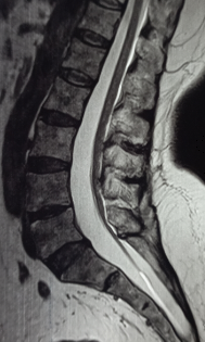 Adult tethered cord syndrome