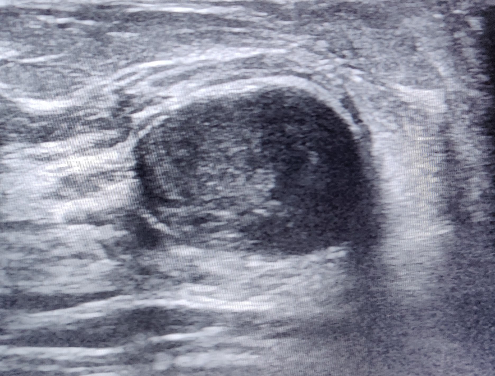 <p>Inspissated Galactocele. Ultrasonographic depiction of a round echoic cyst suggestive of inspissated galactocele.</p>