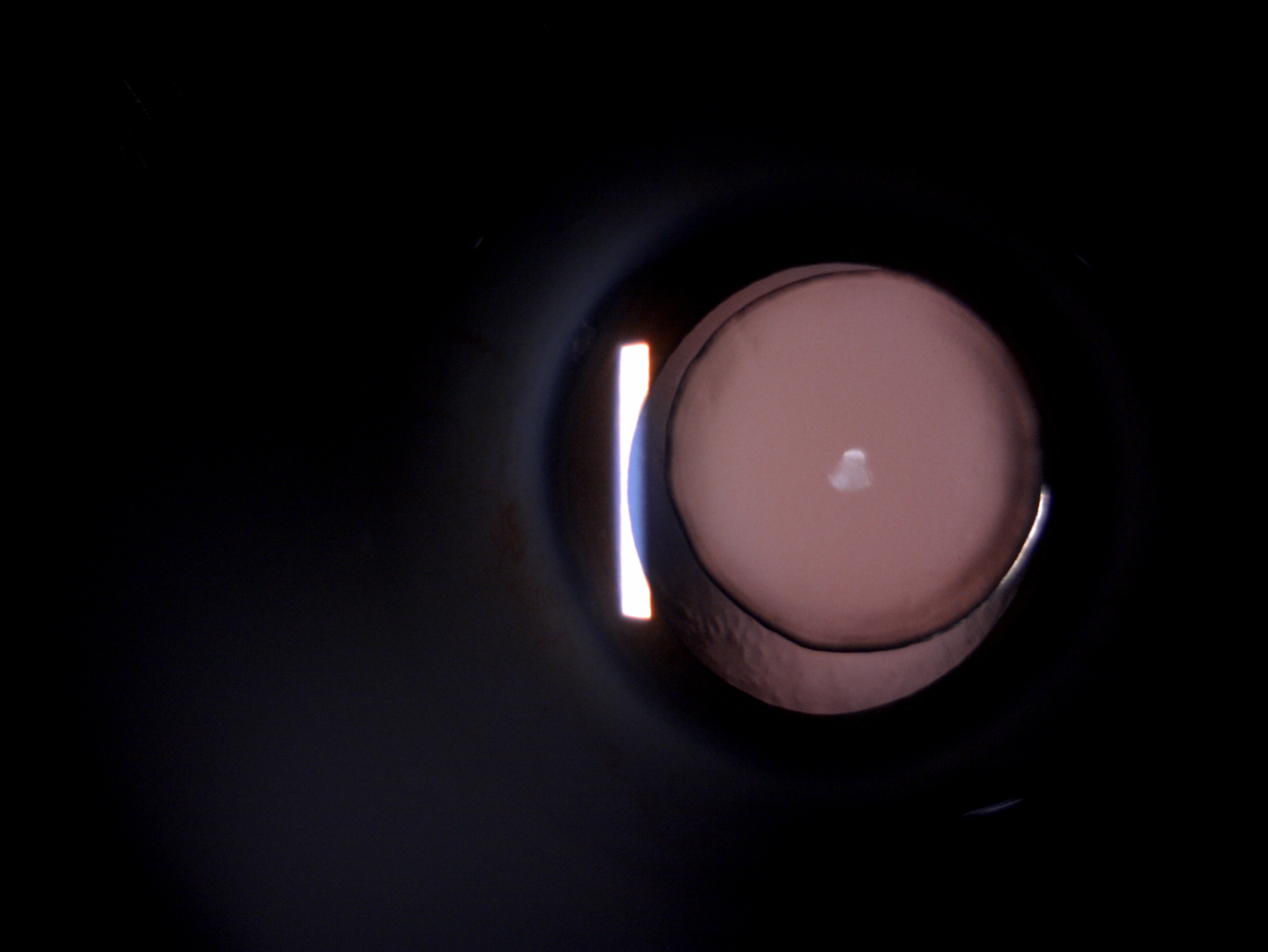Slit lamp image of the patient depicting microspherophakic lens with ectopia lentis in a patient with Weill-Marchesani syndrome. The 360 degree deficiency of zonules can be easily made out.