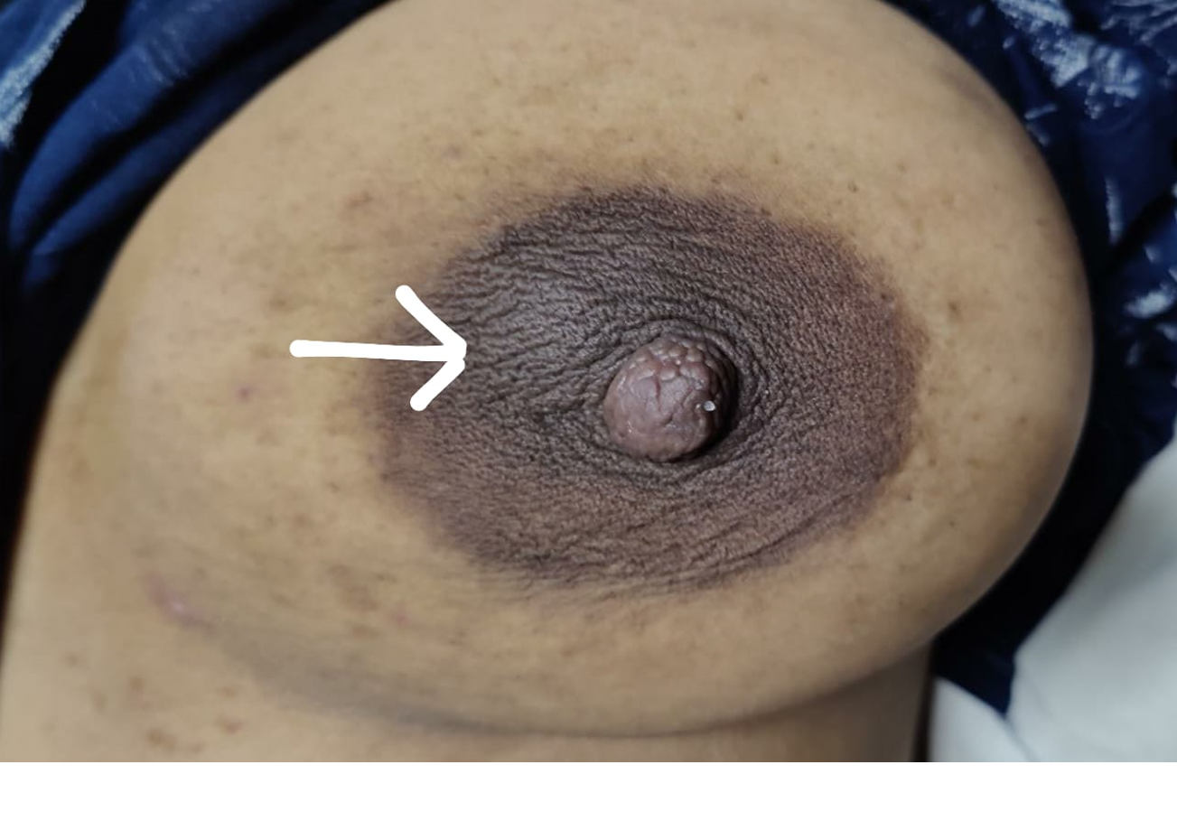 <p>Galactocele, Retroareolar Region of Left Breast