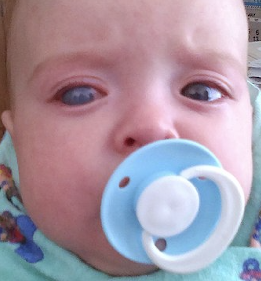 Example of buphthalmos of the right eye in an infant.