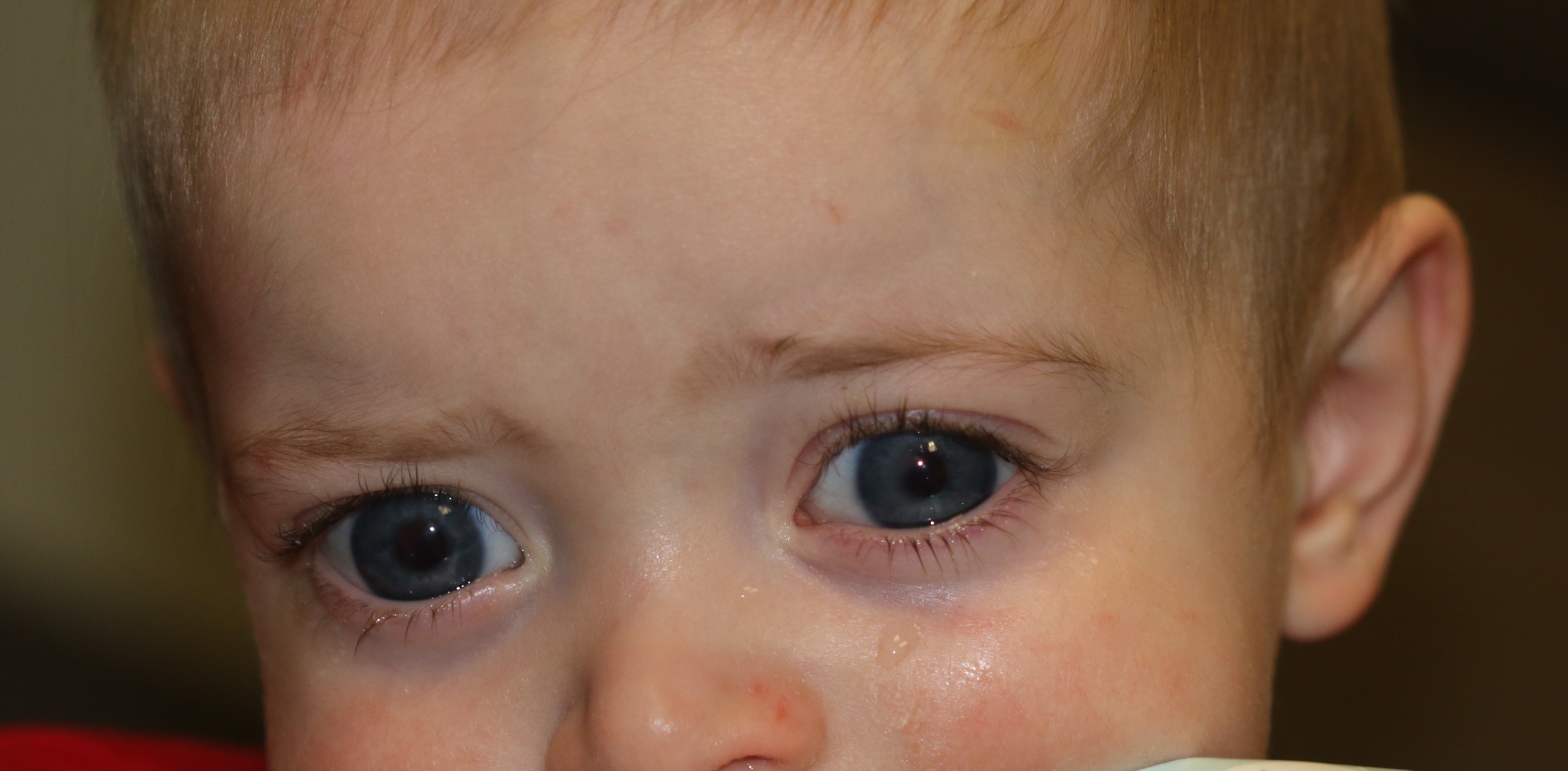 Buphthalmos in a 9-month-old male who presents with bilateral tearing and light sensitivity. Bilateral enlargement of the globes is seen with enlargement of the corneas with tears in the Descemet's membrane ind inferior corneal edema. The sclera shows a bluish appearance because of thinning of the sclera and the uveal tissue showing through. Thecorneal diameter is 13 mm (normal is 10.5 mm in a child this age). The intraocular pressure is 35 mm Hg in the right eye and 38 mm Hg in the left.
