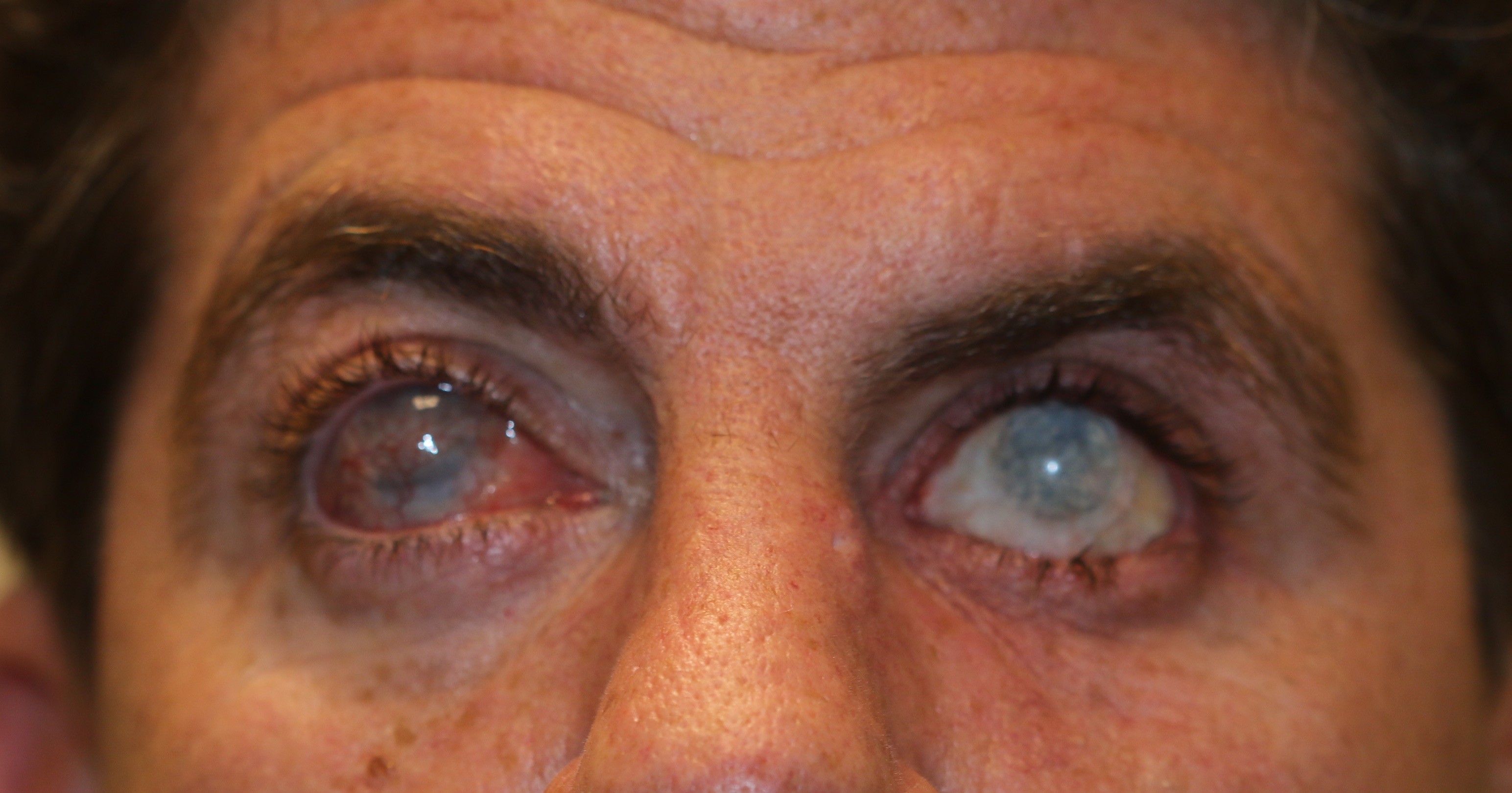 Buphthalmos in an adult. This patient had buphthalmos as a child which was inadequately treated. Enlargement of the globes is seen together with opacification of the corneas