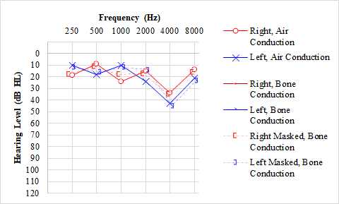 Audiogram, Noise-induced Hearing Loss