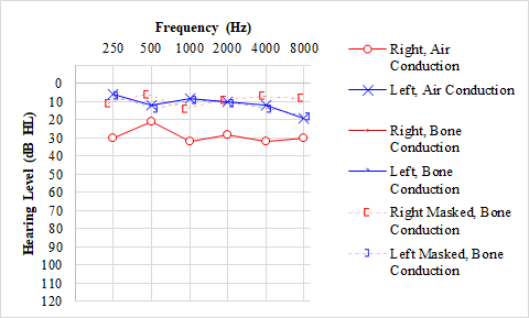 <p>Audiogram, Otitis Media With Effusion