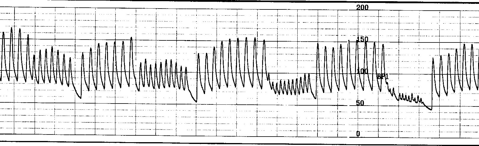 Effect of a sudden heart rate increase on blood pressure