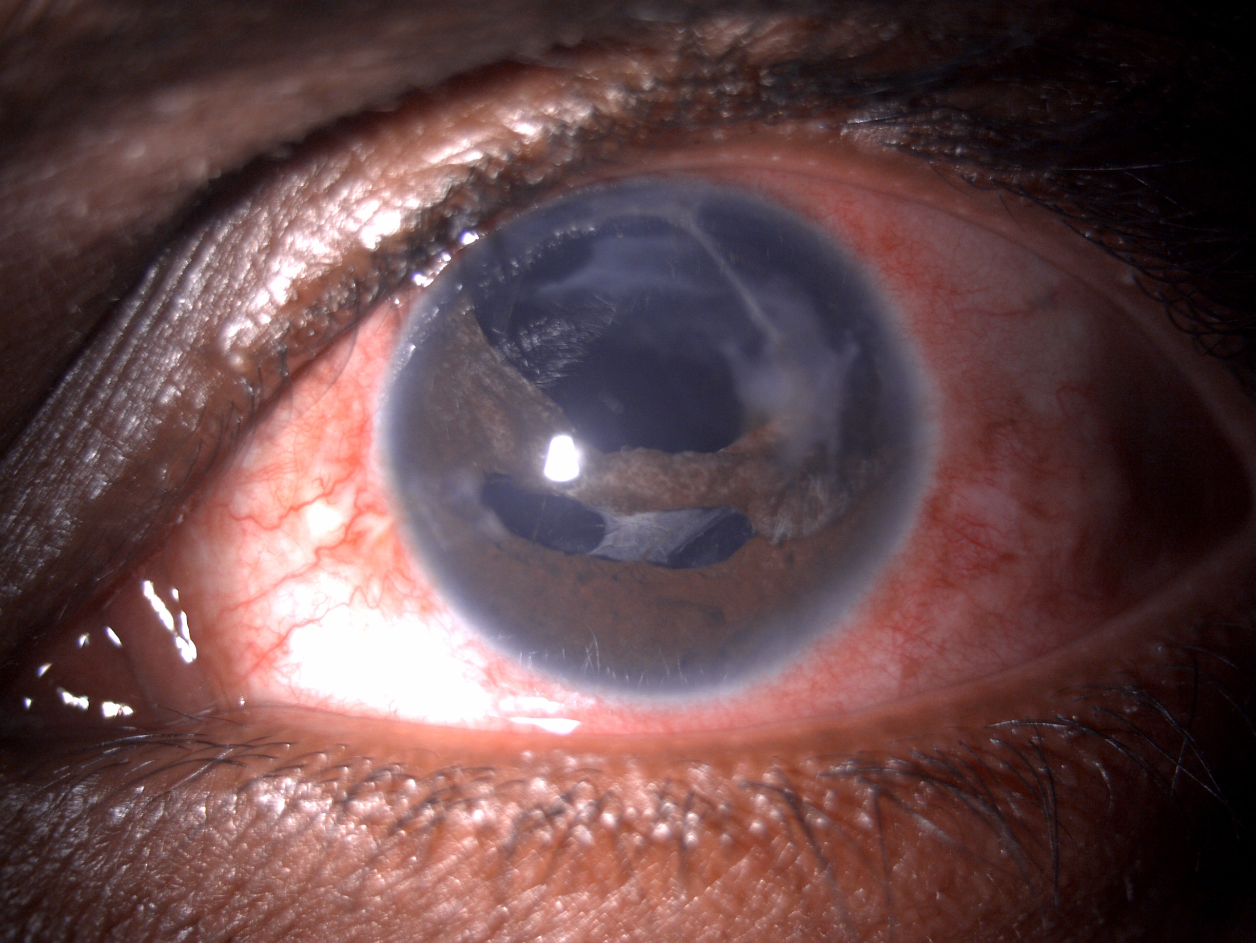 Slit lamp image of the patient depicting large traumatic iridodialysis from 10 o'clock to 3 o'clock, correctopia, ectopic pup