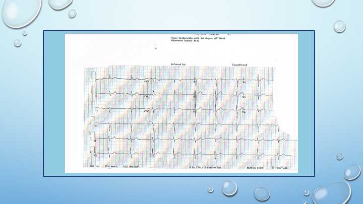 Sinus Bradycardia with First Degree AV Block ECG example