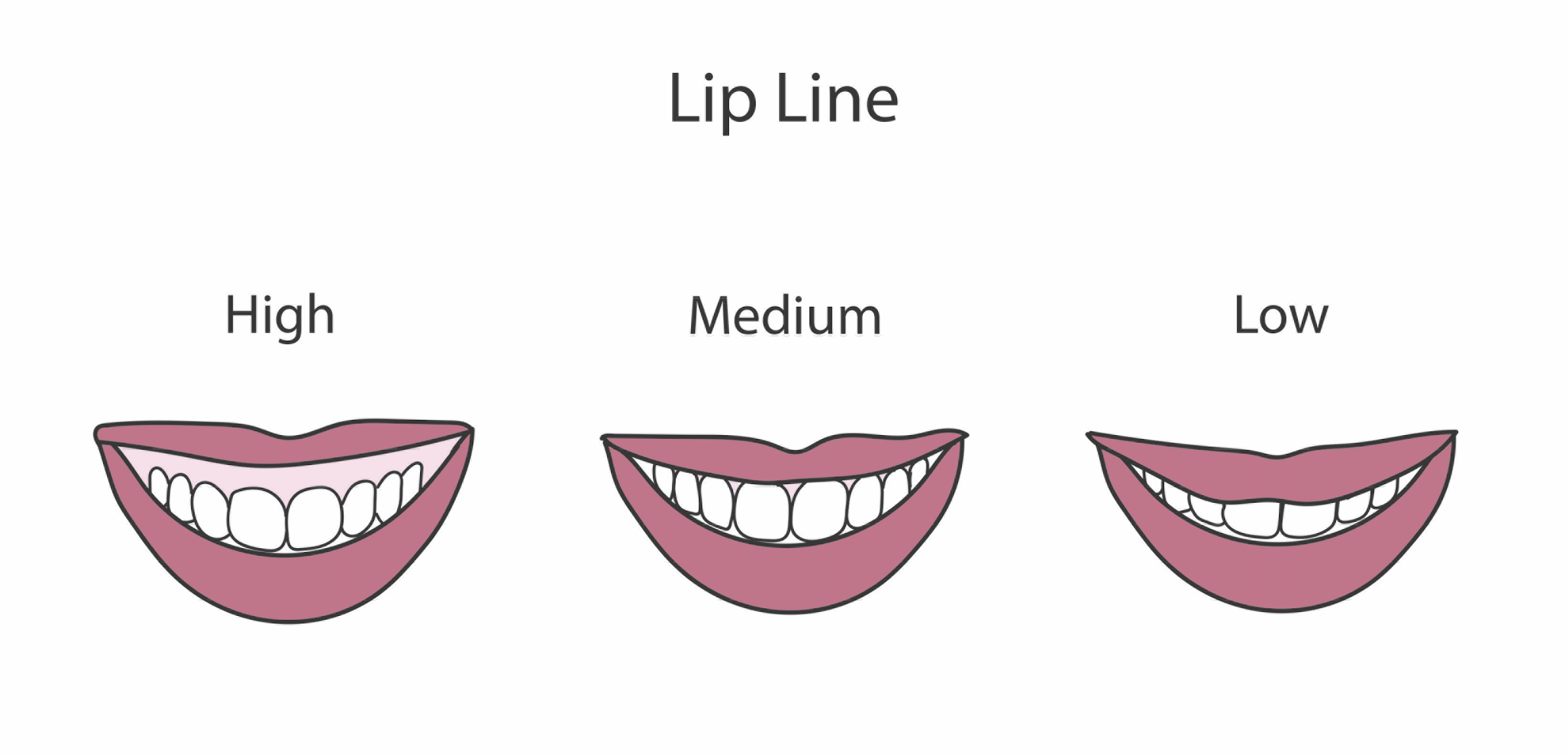 <p>Lip Lines. The illustrated image shows examples&nbsp;of low, medium, and high lip lines.</p>