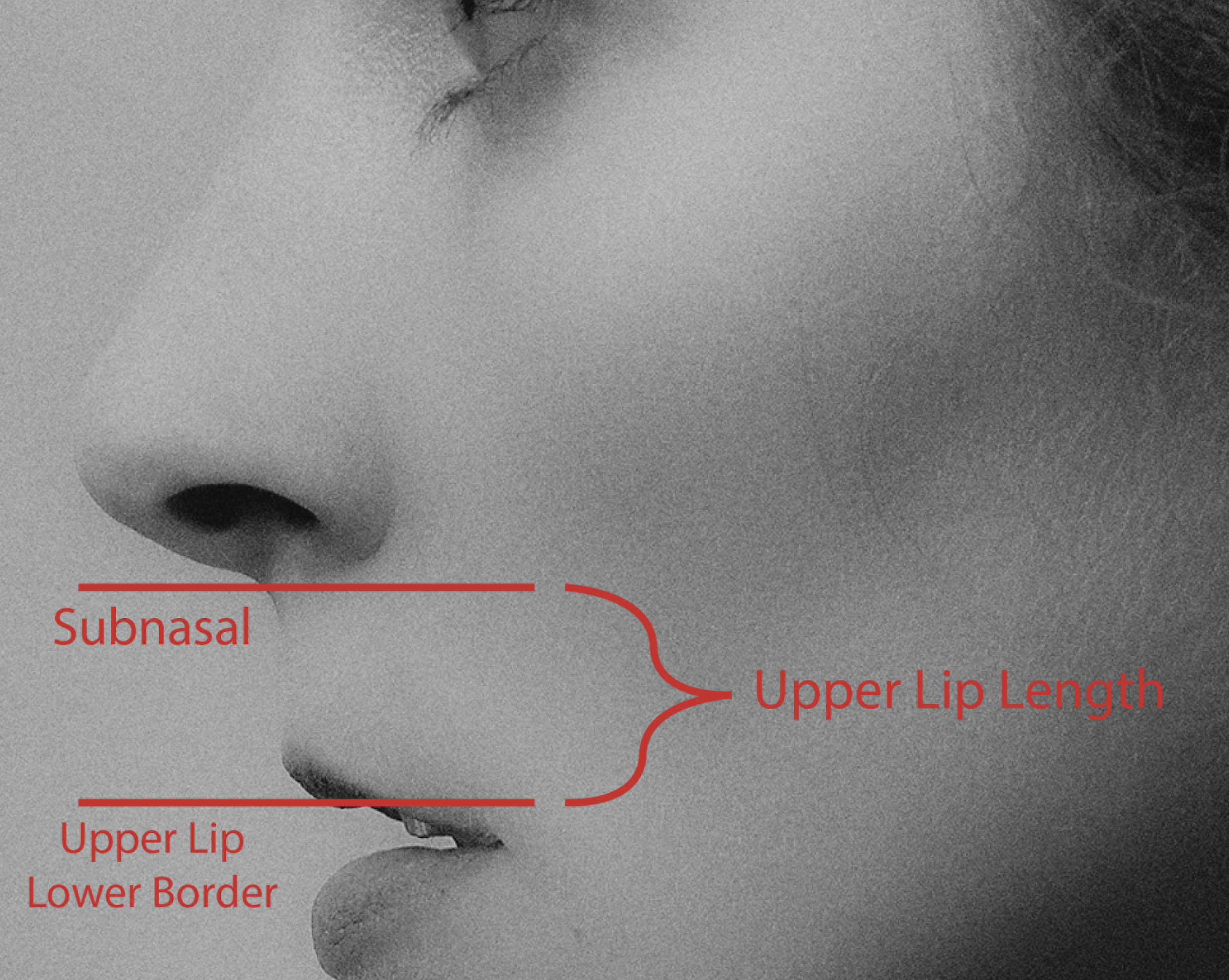 <p>Upper Lip Length Measurement.</p>