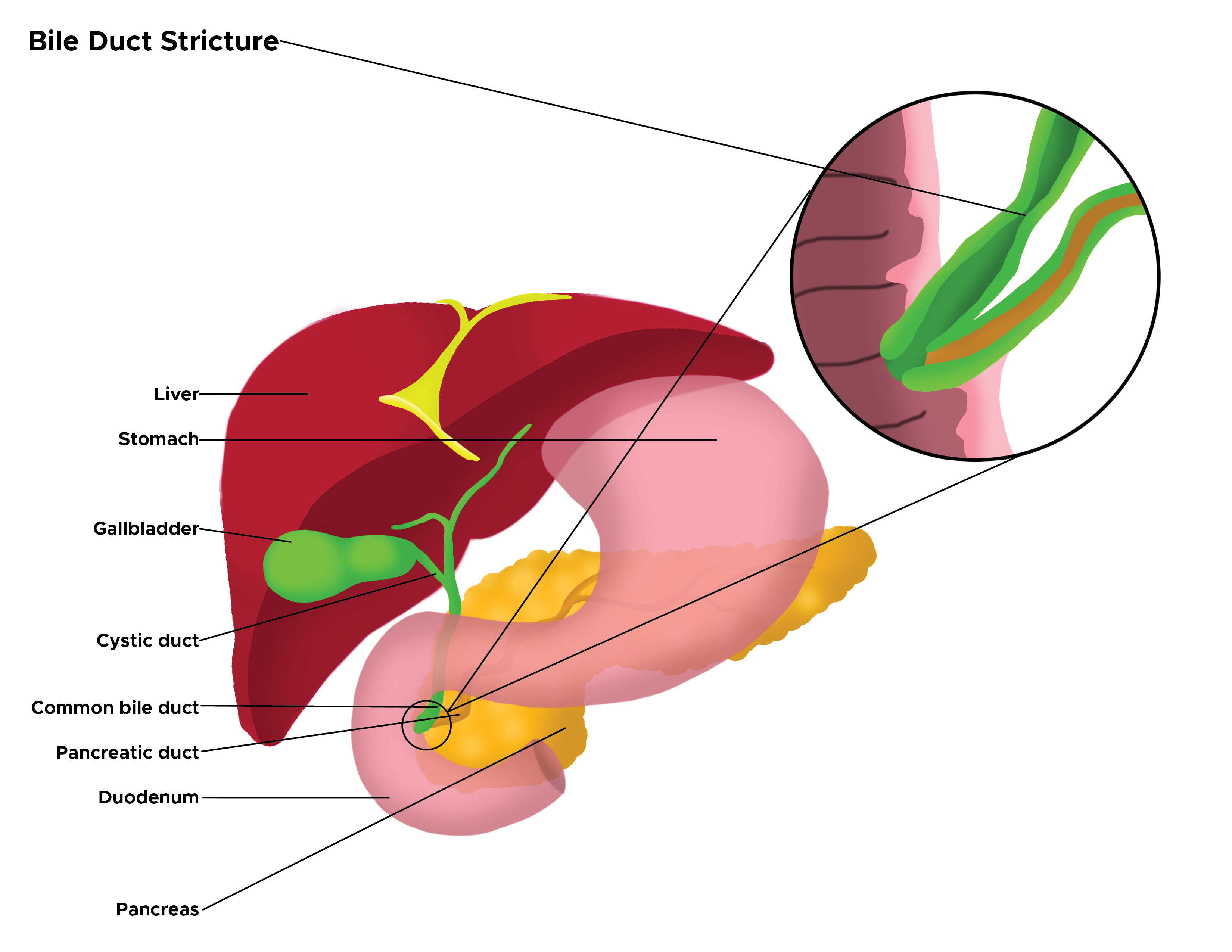Illustration of bile duct stricture. Liver, stomach, gallbladder, cystic duct, common bile duct, pancreatic duct, duodenum, pancreas.