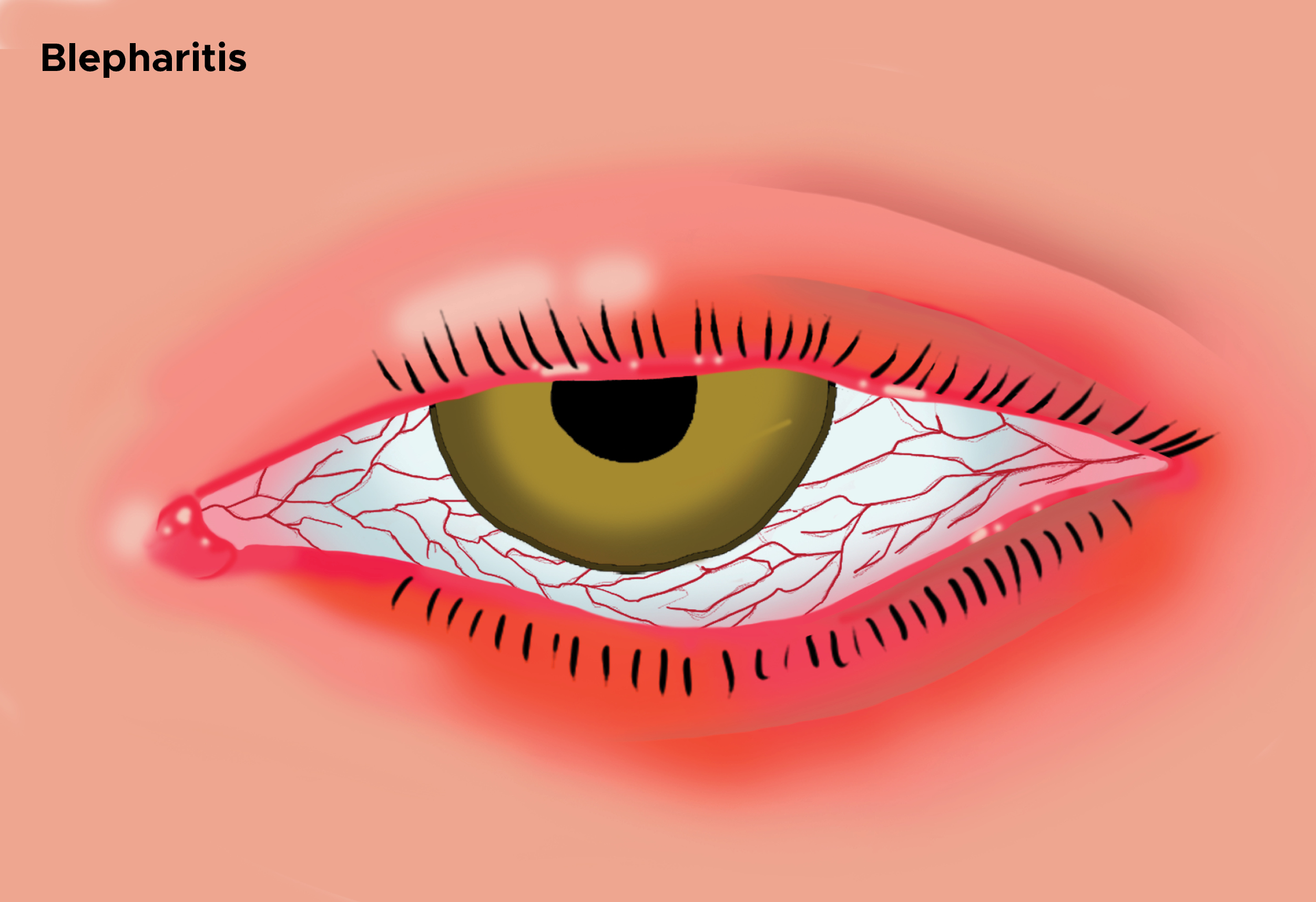 <p>Illustration of Blepharitis Showing Swollen Eyelid.</p>