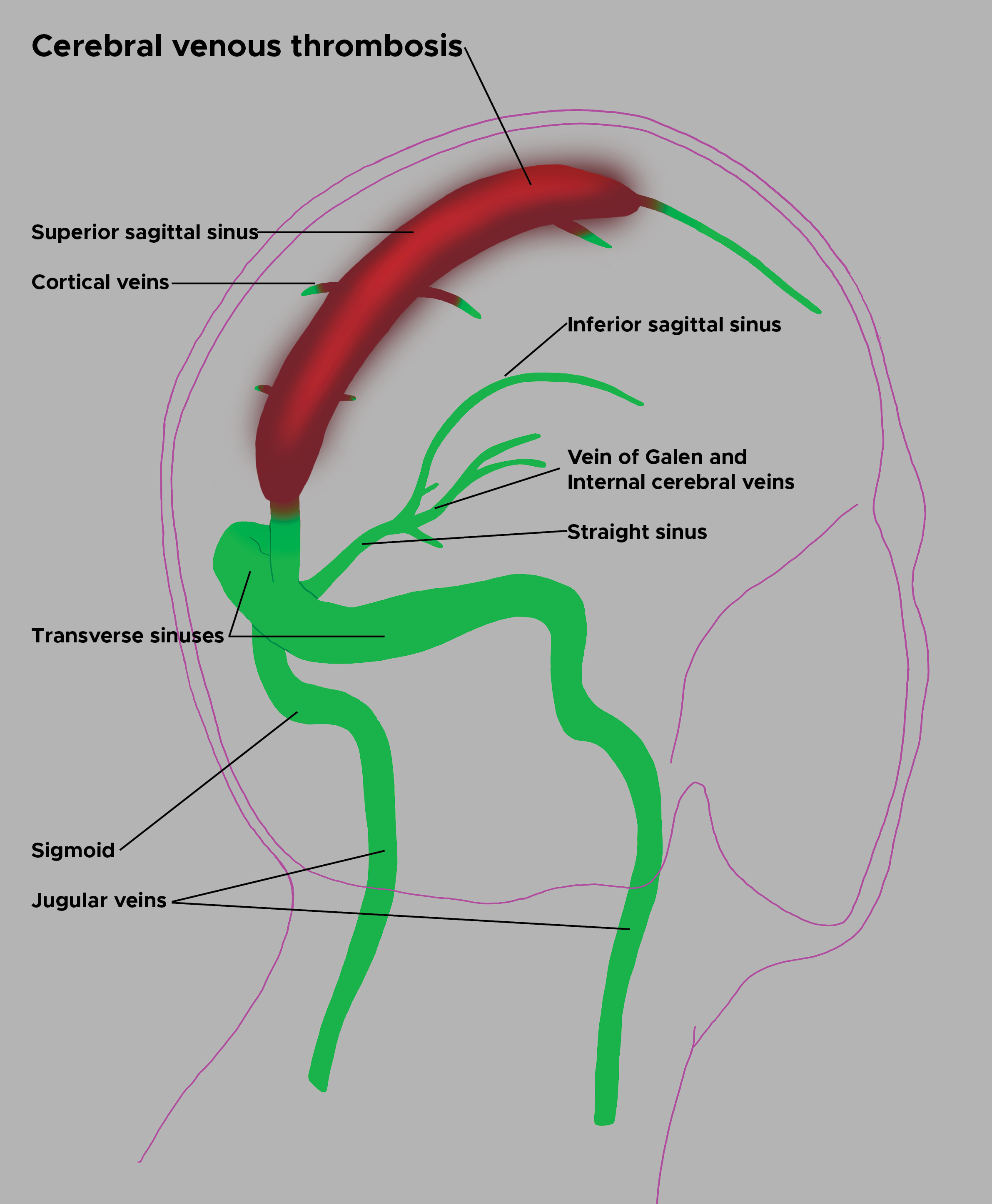 Illustration of cerebral venous thrombosis. Superior sagittal sinus, cortical veins, inferior sagittal sinus, Vein of Galen, internal cerebral veins, straight sinus, transverse sinus, sigmoid, jugular veins.