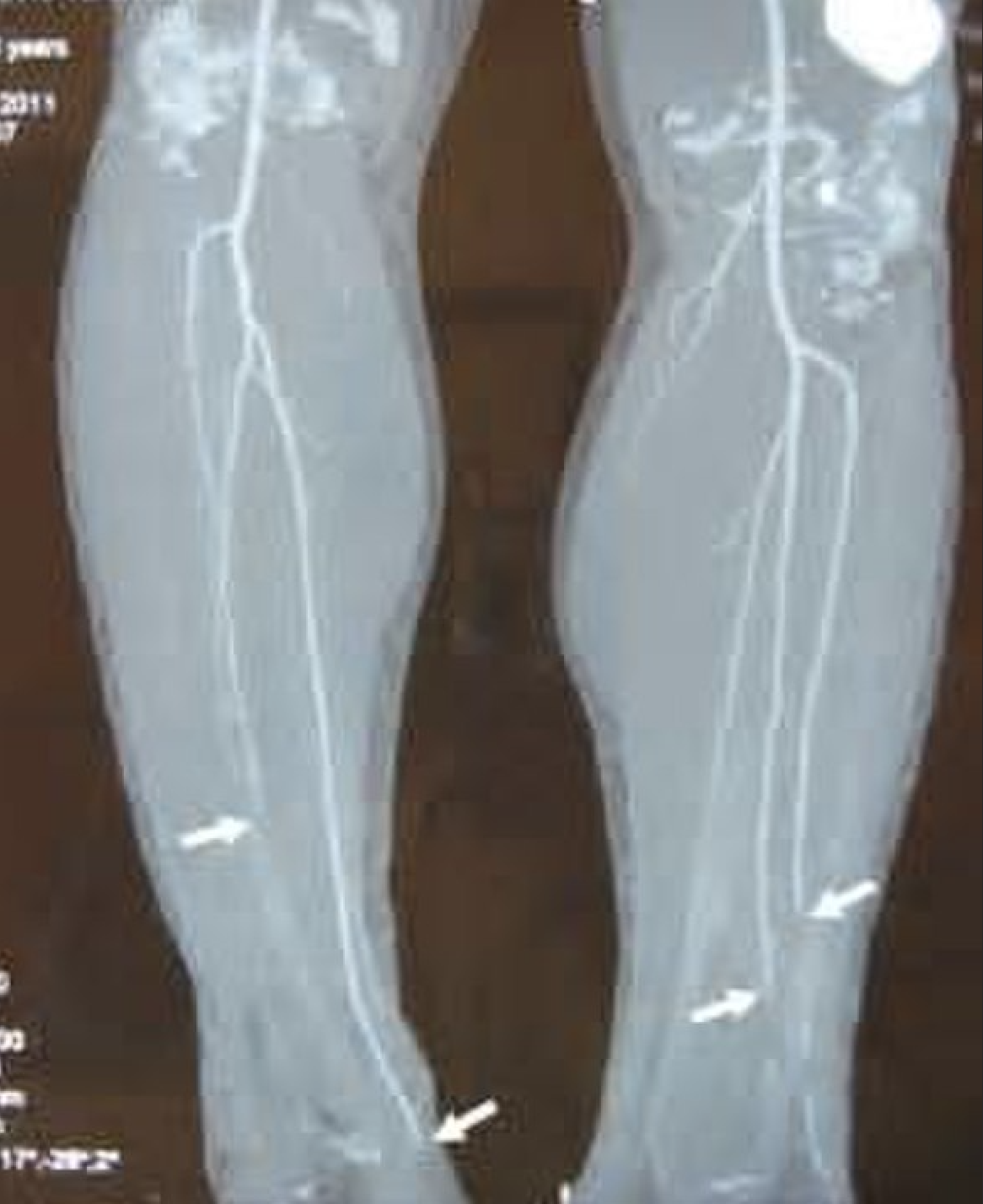 CT angiography of middle aged patient with Buerger disease, arrows point to areas of occlusion.