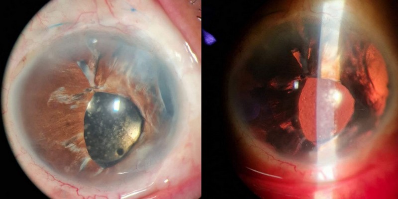 <p>Uveitis Glaucoma Hyphema Syndrome or Ellingson Syndrome