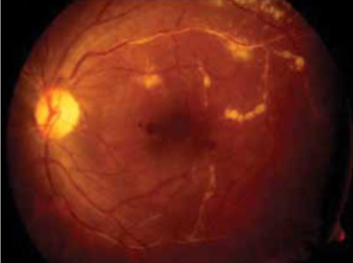 Figure 2: Fundus photography of left eye show mid peripheral vasculitis with yellowish-white perivascular exudates (candle wa