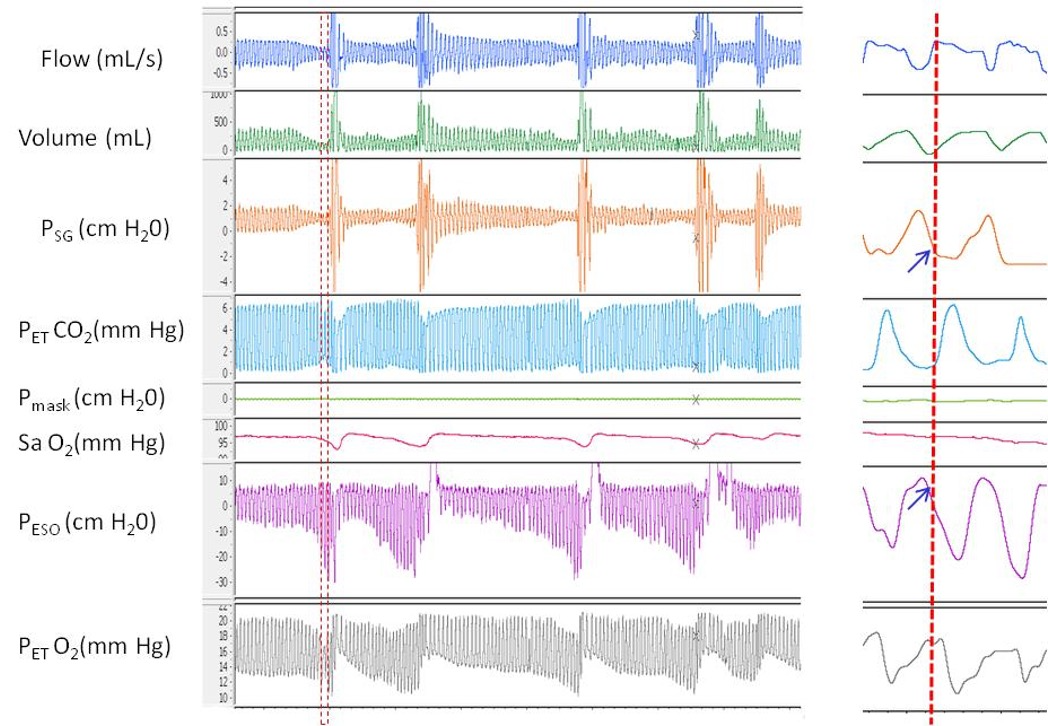 A polygraph illustrating the pressure flow relationship during repetitive episodes of inspiratory flow limitation