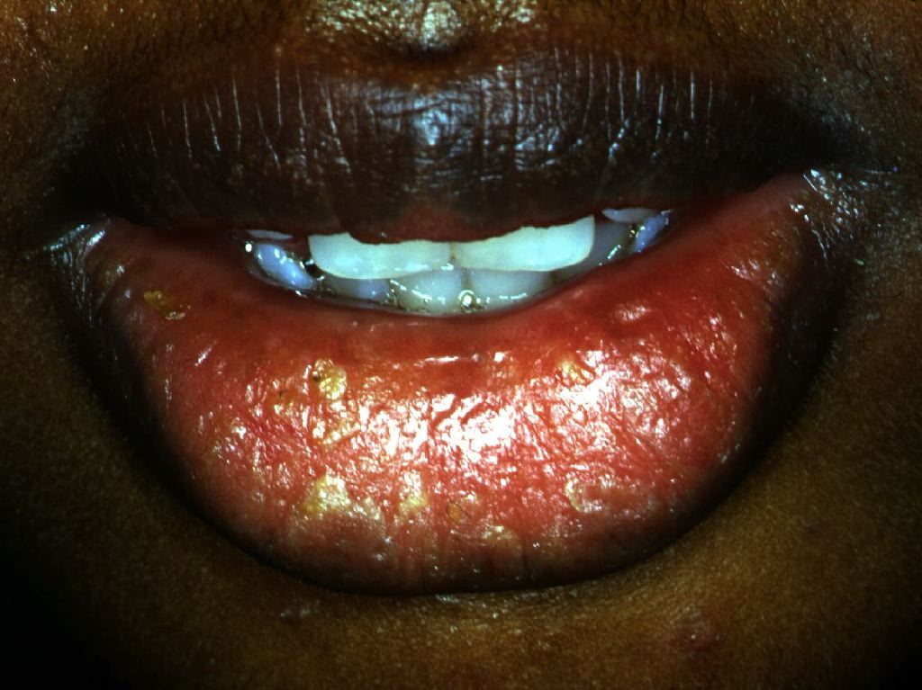 <p>Cheilitis Glandularis</p>