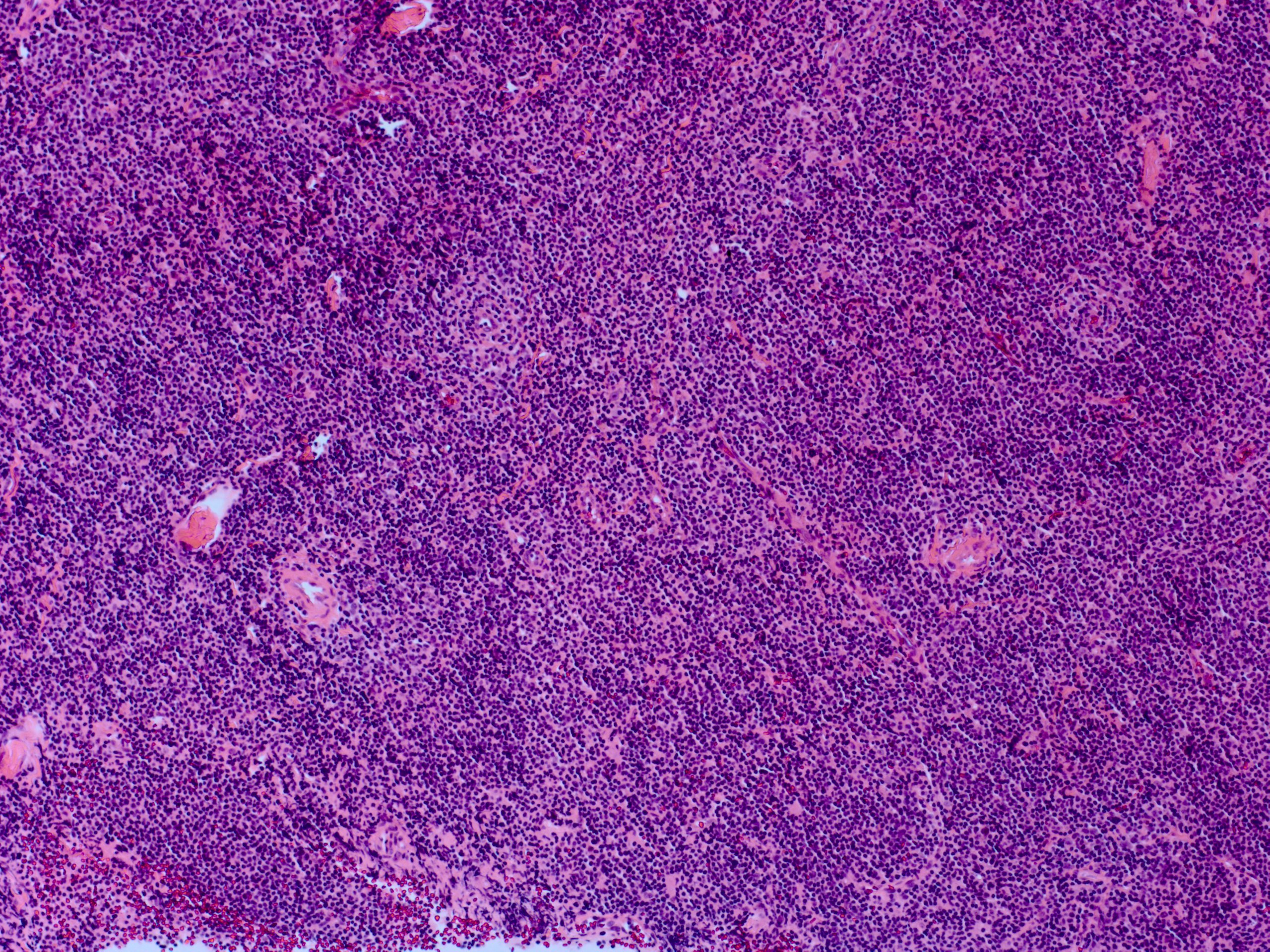 <p>Lacrimal Gland Lymphoma, 25&times; View</p>