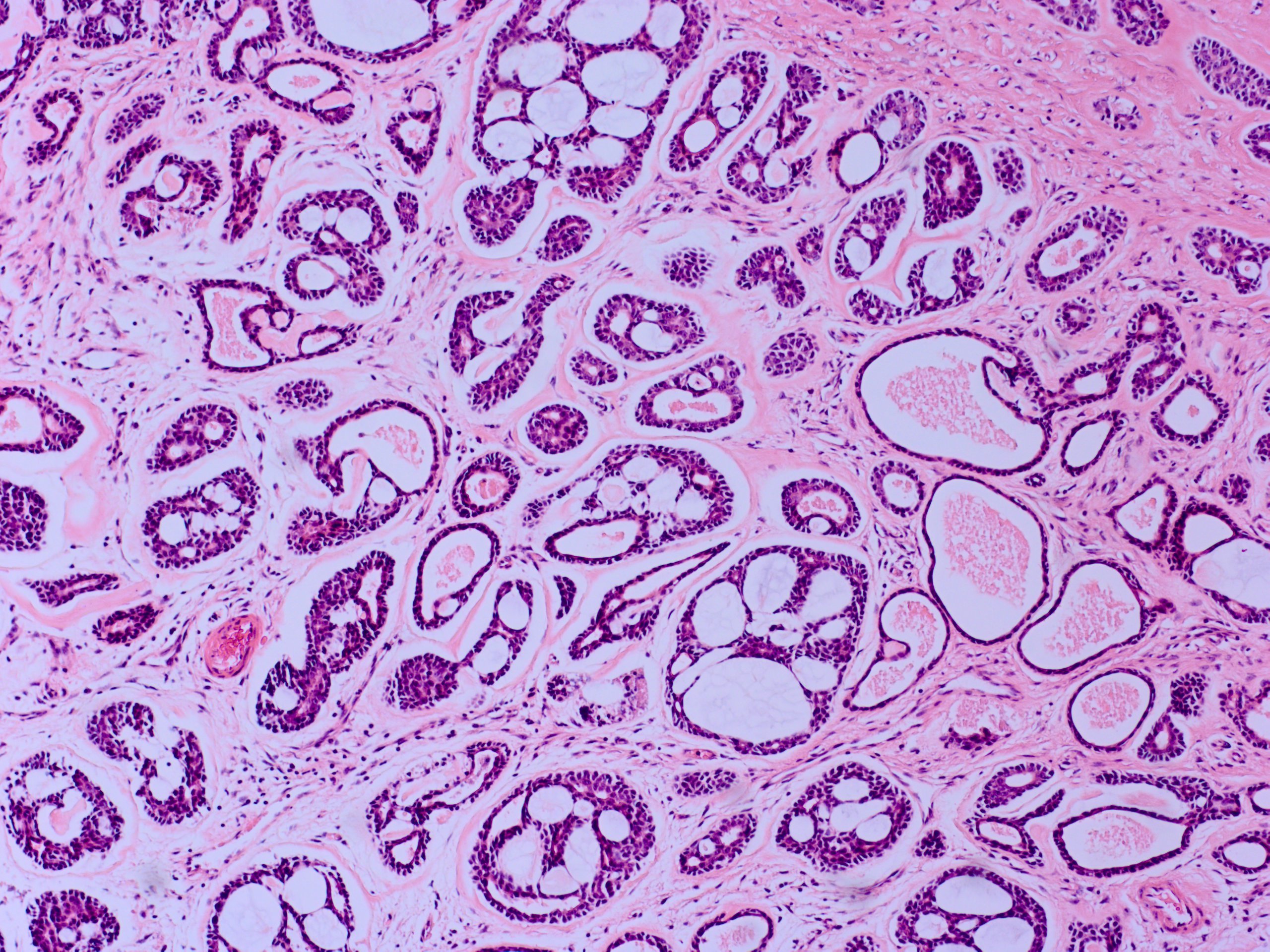 <p>Lacrimal Gland Adenoid Cystic Carcinoma 25&times;</p>