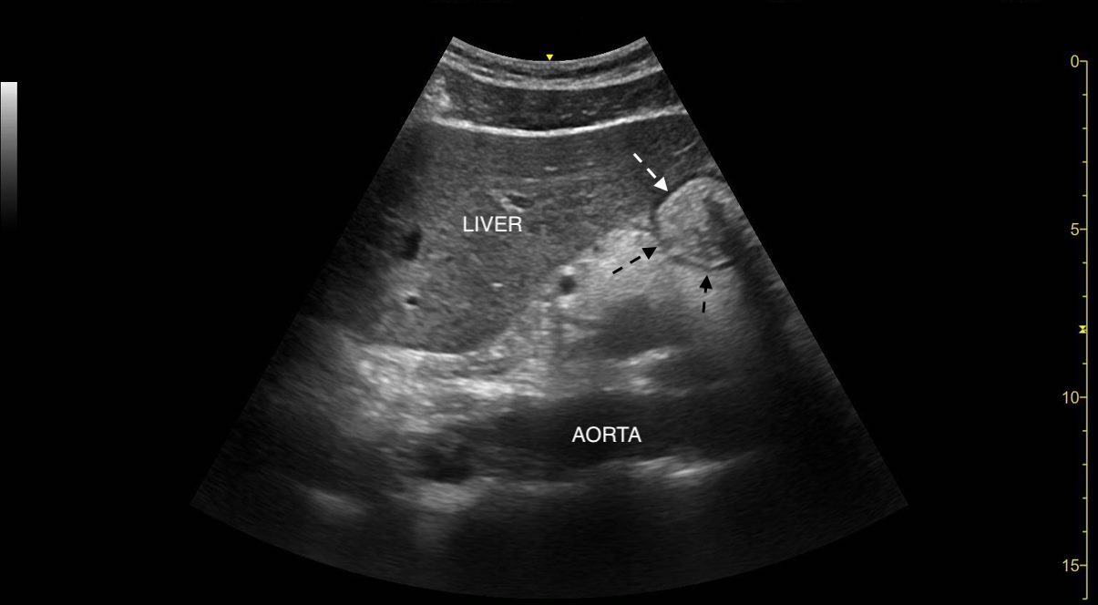 <p>Gastric Ultrasound,&nbsp;Hypoechoic Muscular Layer of the Stomach