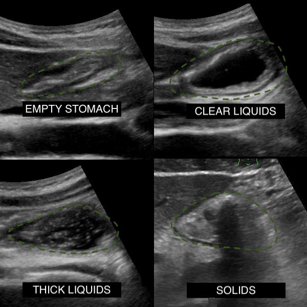 <p>Gastric Ultrasound, Assessment of&nbsp;Gastric&nbsp;Contents