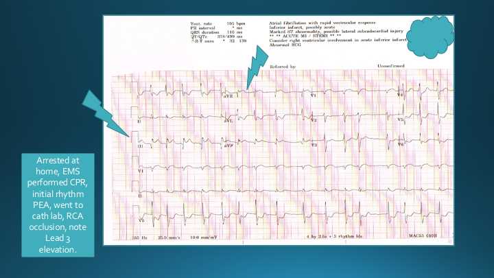 ECG of Acute MI with RCA occlusion.