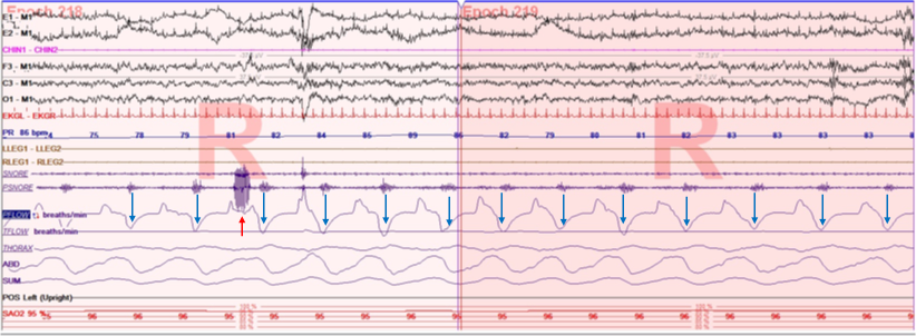 <p>Flow Limitations with Snoring