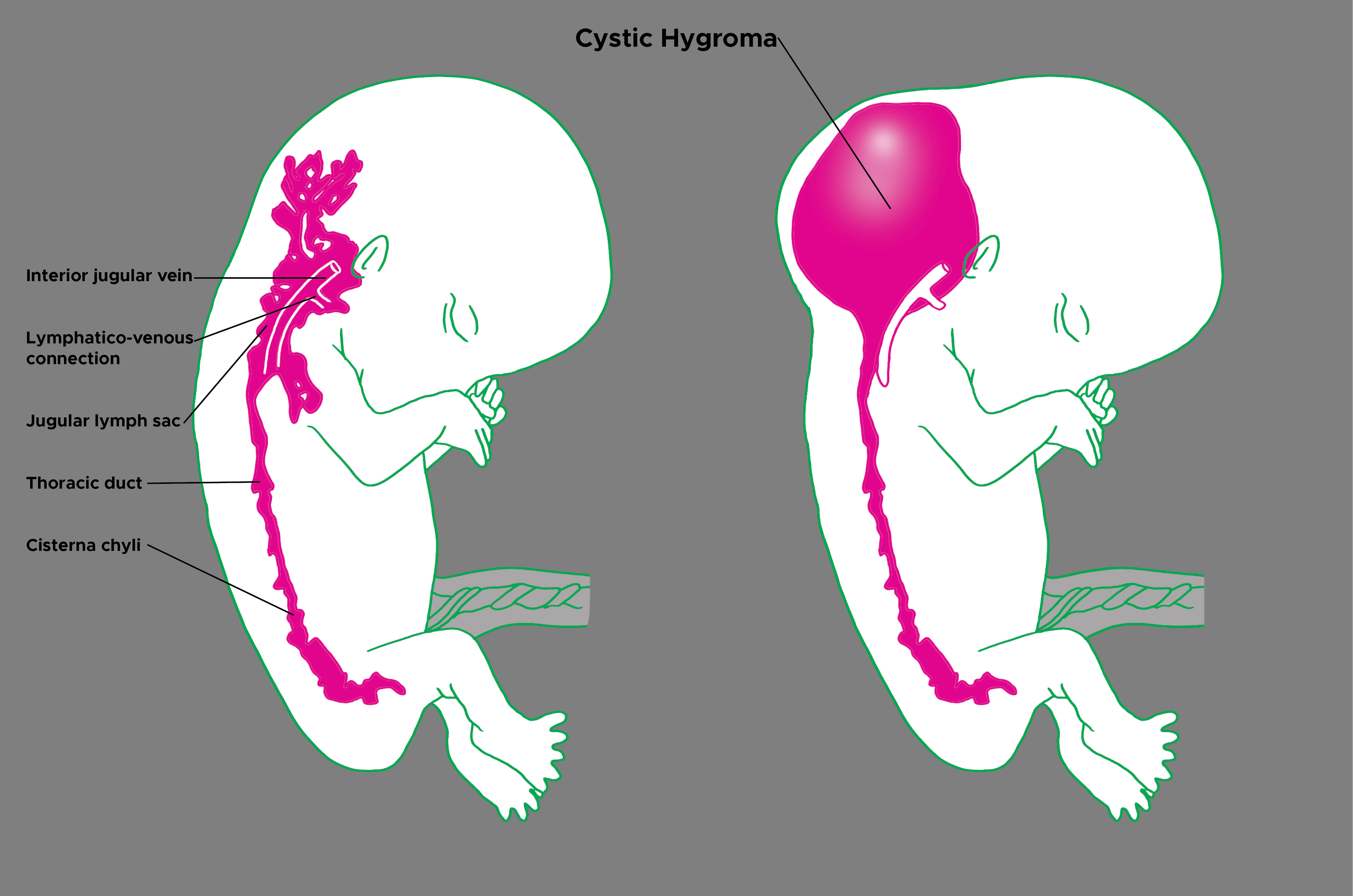 <p>Illustration of Normal Fetus and Fetus With Cystic Hygroma.</p>