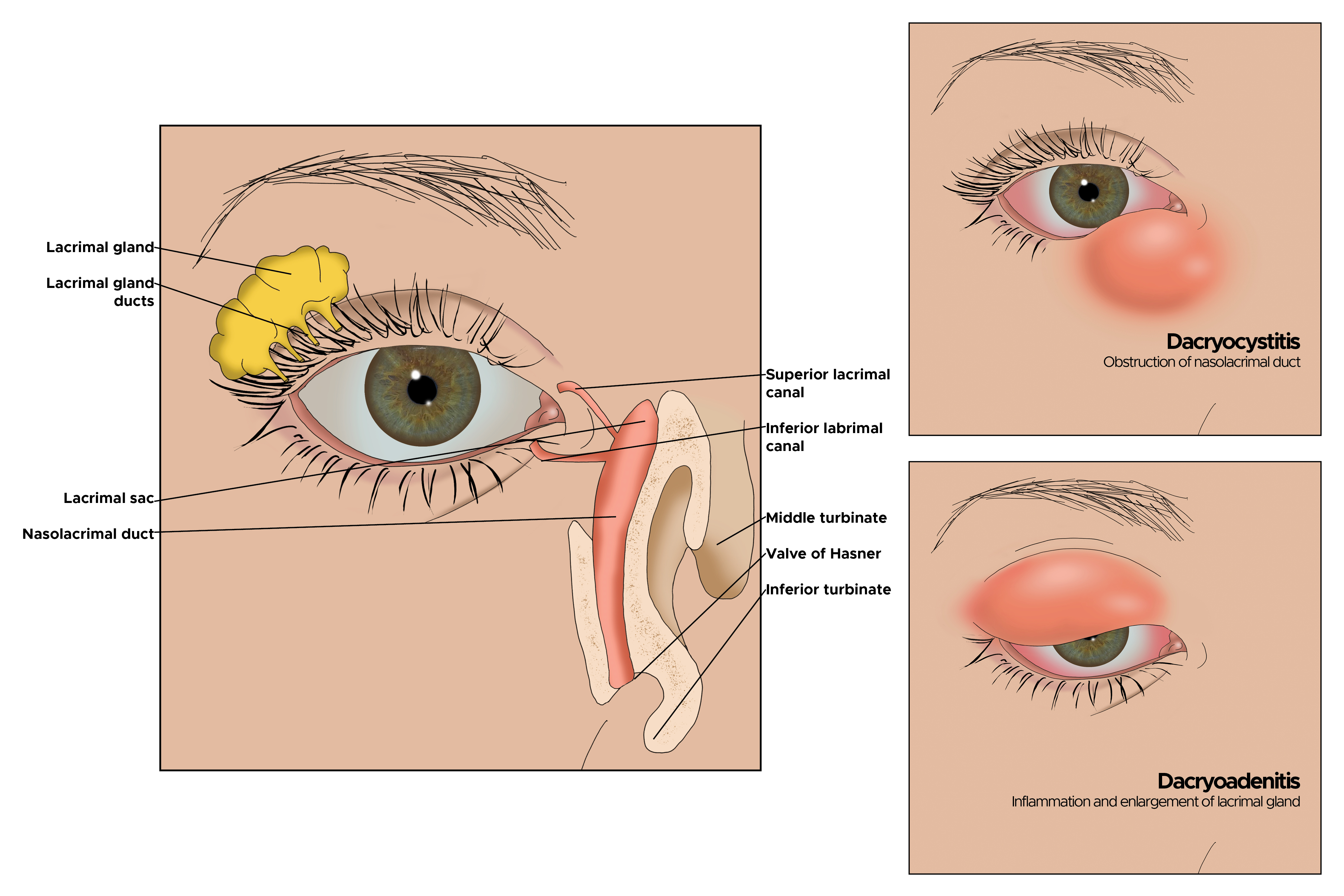 <p>Dacryoadenitis