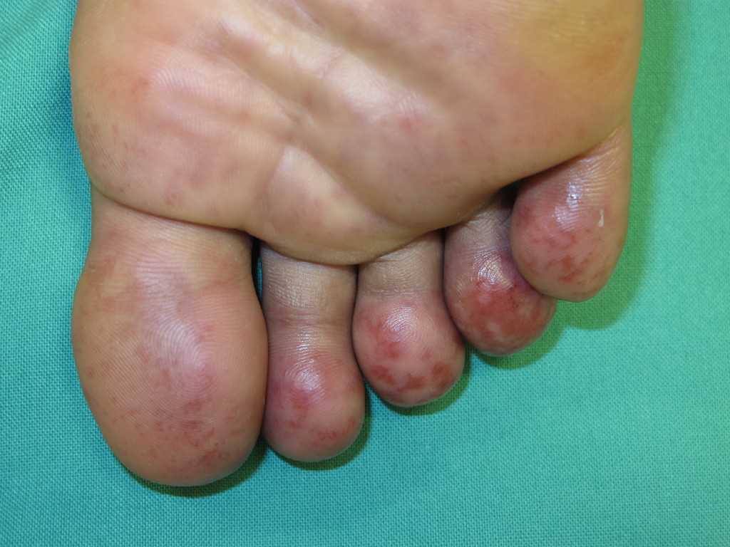 <p>Chilblains</p>