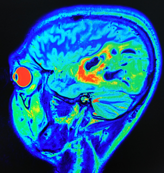 <p>Hemorrhagic Infarction of the Brain, Computed Tomography