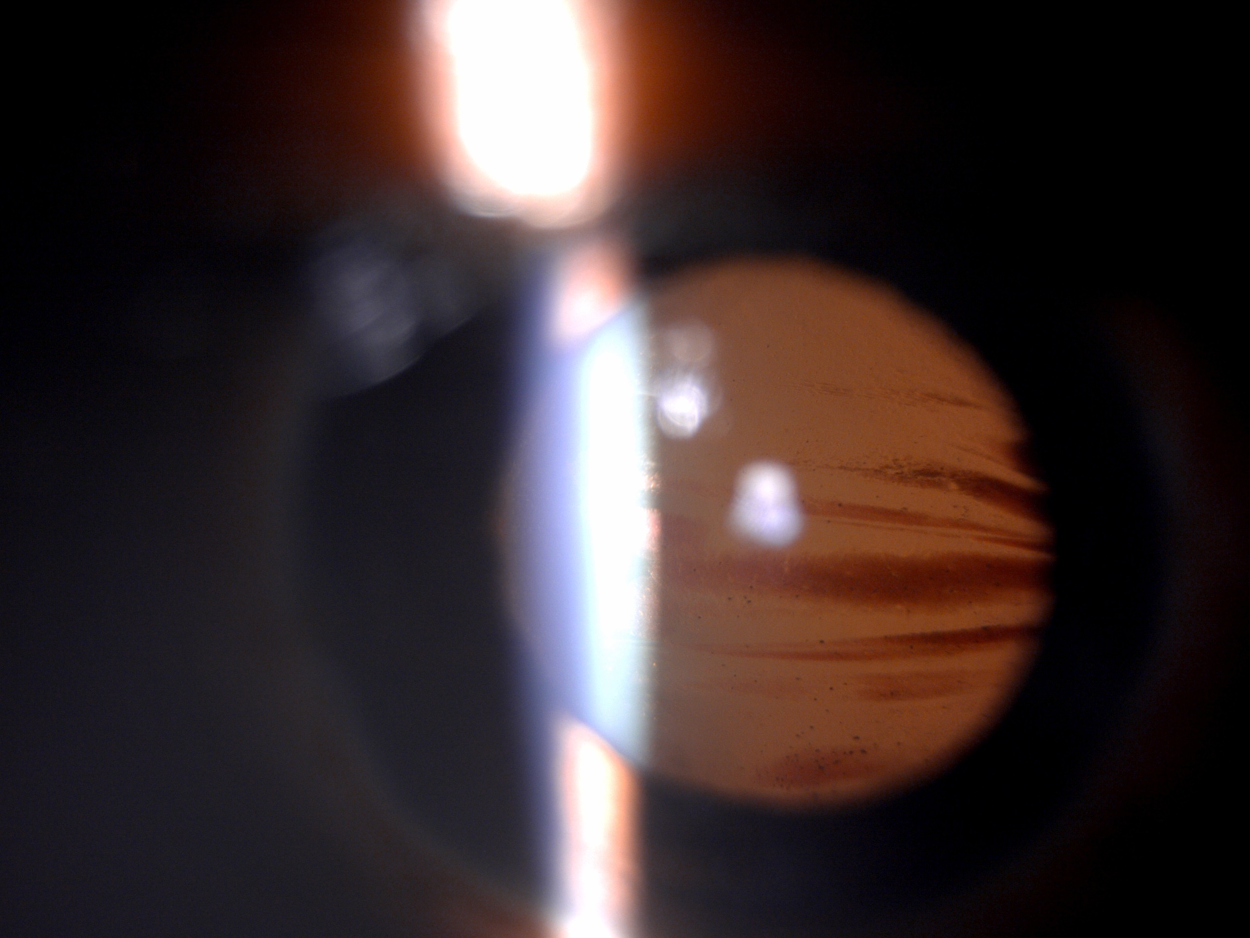 Slit lamp image of the patient with blunt ocular trauma (closed globe injury) depicting blood staining of the anterior lens capsule