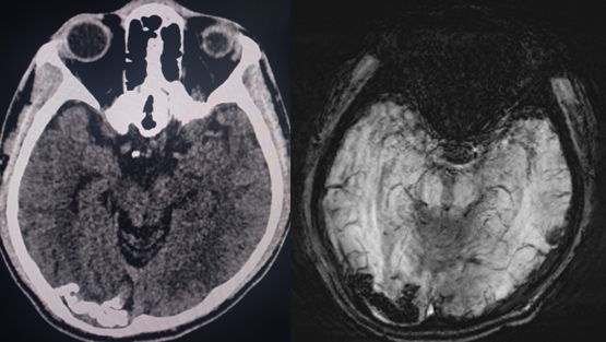 <p>Sturge-Weber Syndrome</p>