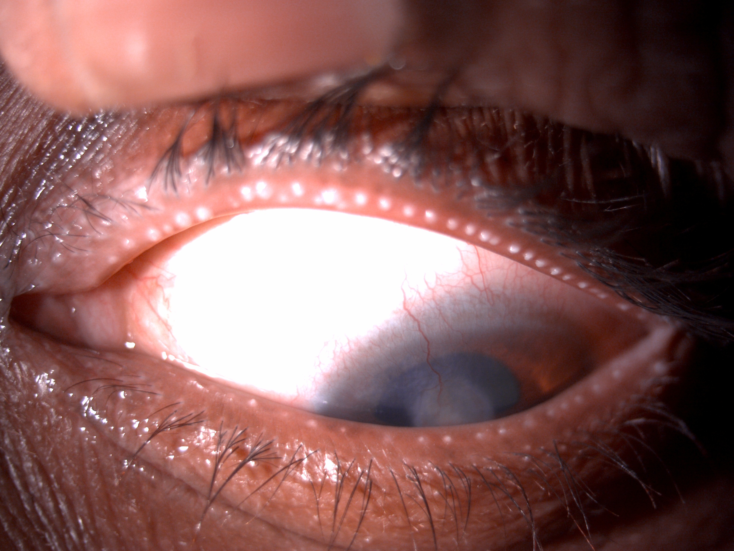 Digital slit lamp image of the patient depicting upper eyelid matted lashes, seborrheic blepharitis in lower eyelashes, upper