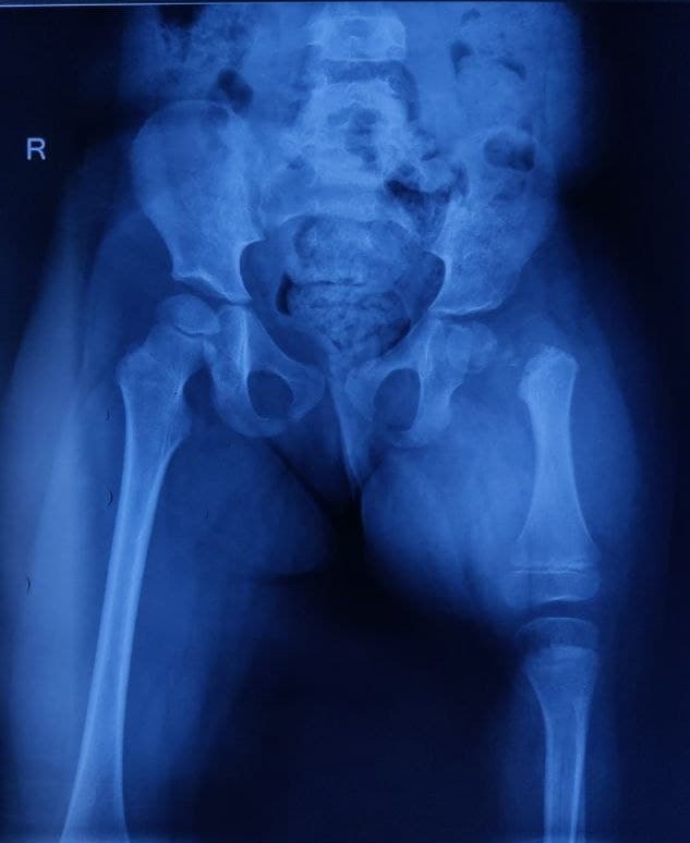 <p>Congenital Femoral Deficiency Radiography