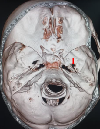 <p>Foramen Ovale.</p>