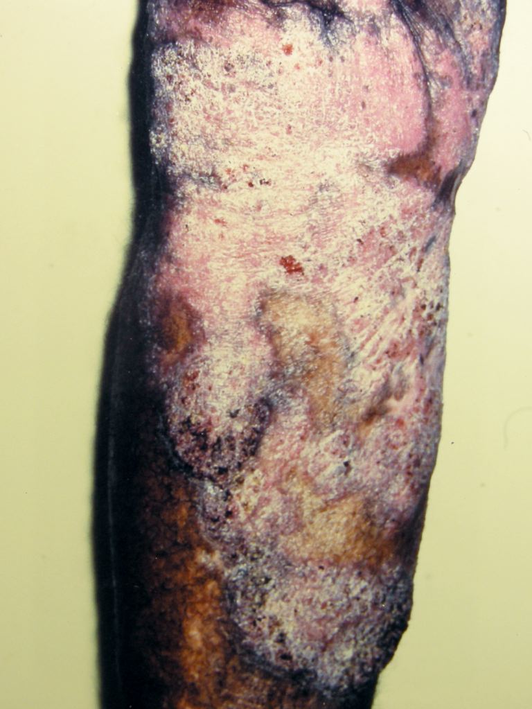 <p>Chromoblastomycosis</p>