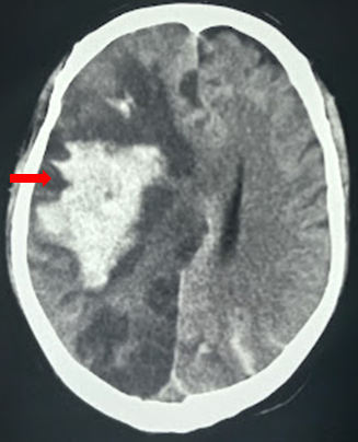 Hemorrhagic transformation within the hemispheric ischemia