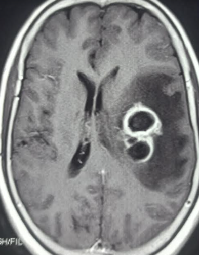 <p>Brain Abscess</p>