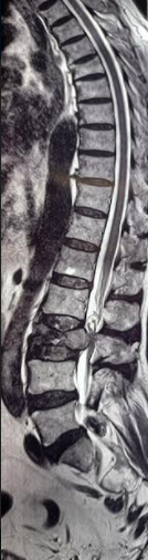 <p>Vertebral Compression Fracture.</p>