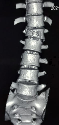 <p>Compression Fracture,&nbsp;Vertebral</p>