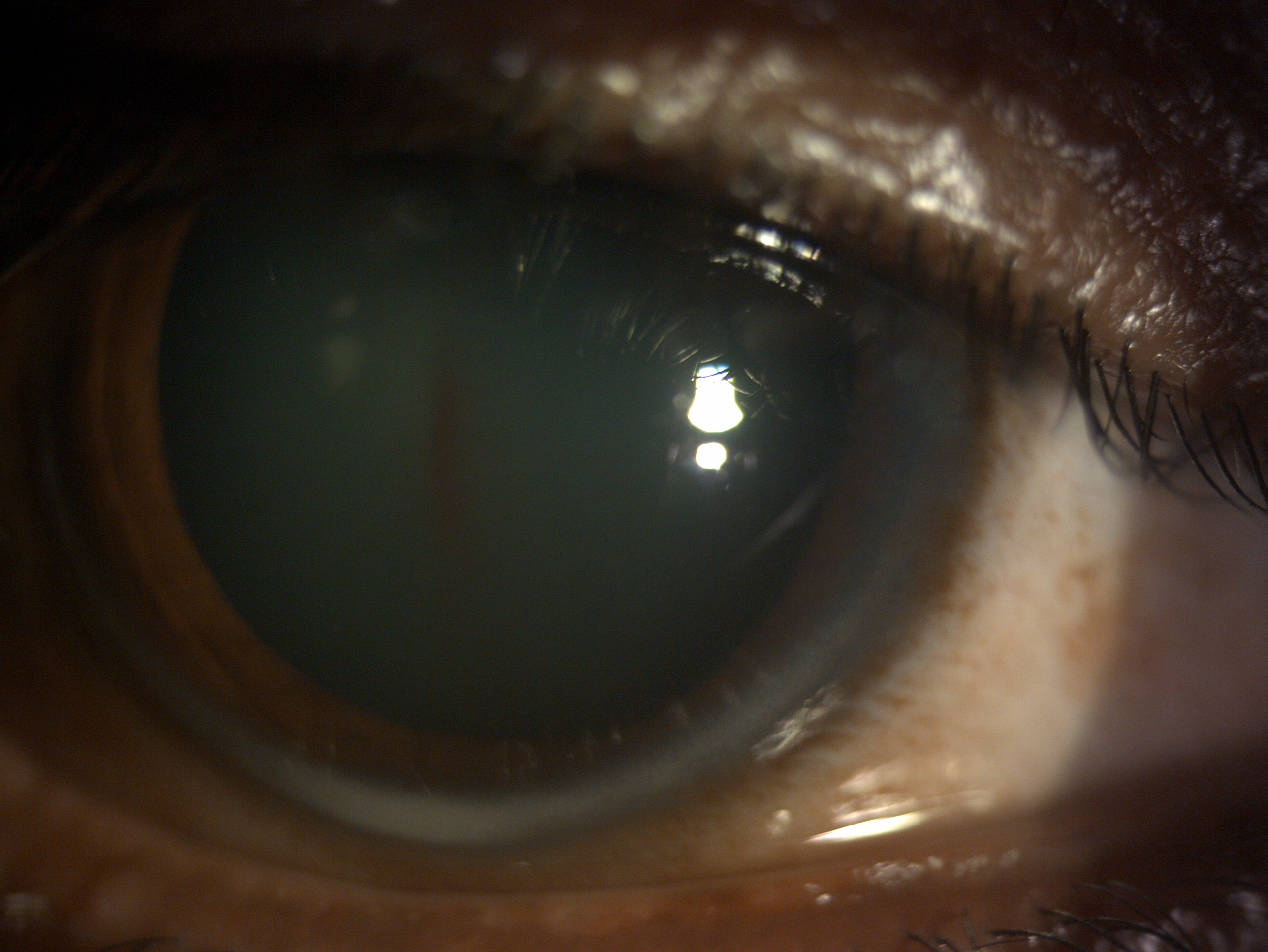 Digital slit lamp image of the patient with pigment dispersion syndrome depicting pigmented line on the anterior lens capsule