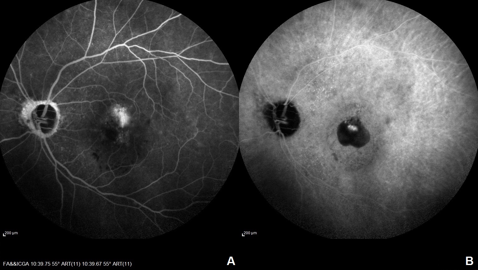 <p>Polypoidal Choroidal Vasculopathy